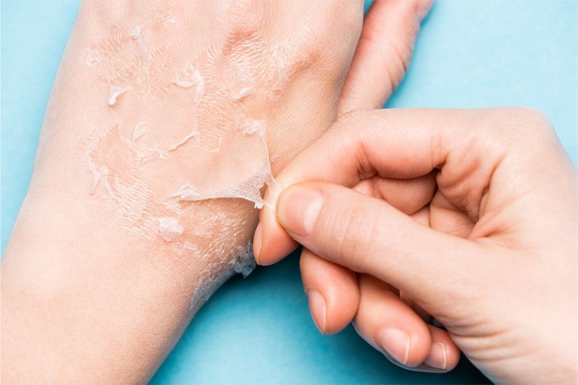 skin-peeling