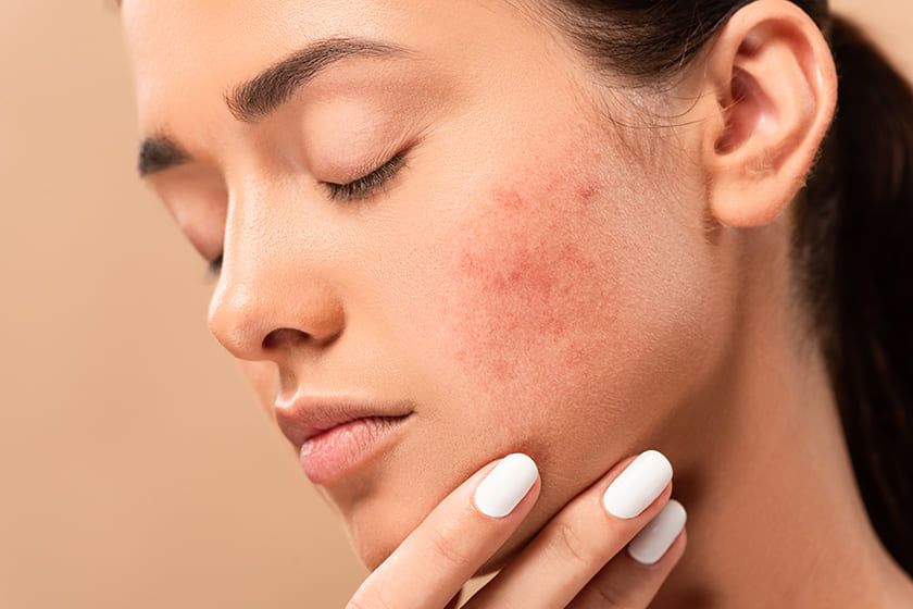 Women with Acne on Face