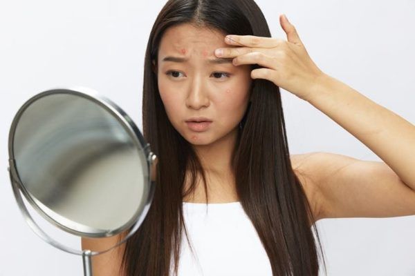 Hormonal Acne: Causes, Treatment & Prevention