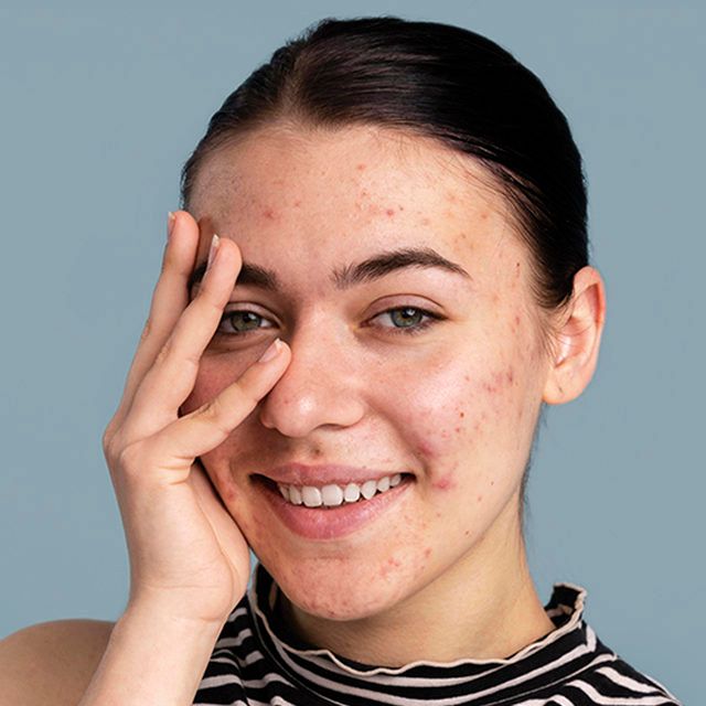 Blemishes On Face