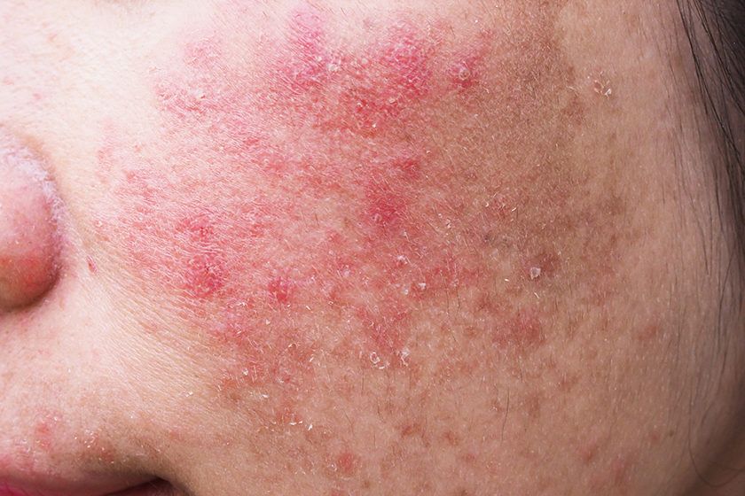 9 Common Mistakes to Avoid When Choosing a Face Cream for Women 2 rash young woman face itchy allergic skin problems dermatitis