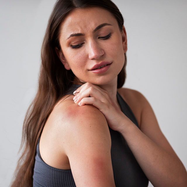 woman suffering from rash- Body Lotion for Summer