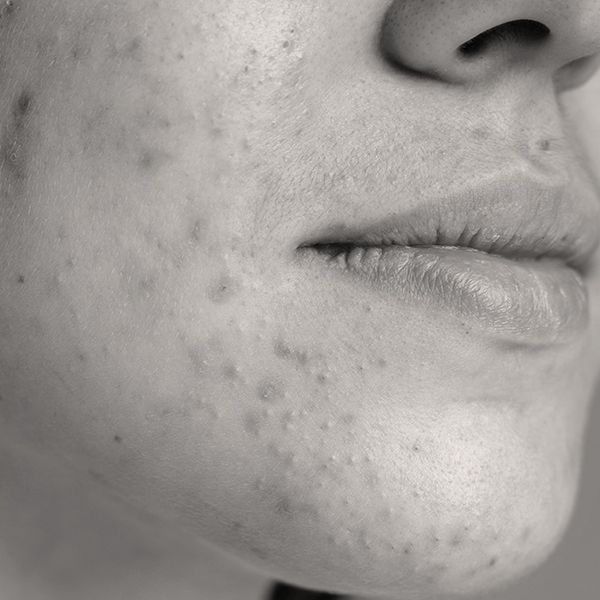 Acne-Prone Skin